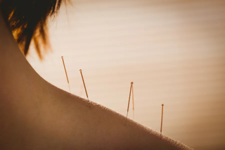Sessão de acupuntura com agulhas aplicadas nas costas de um paciente, numa sala calma da Nutrimed.